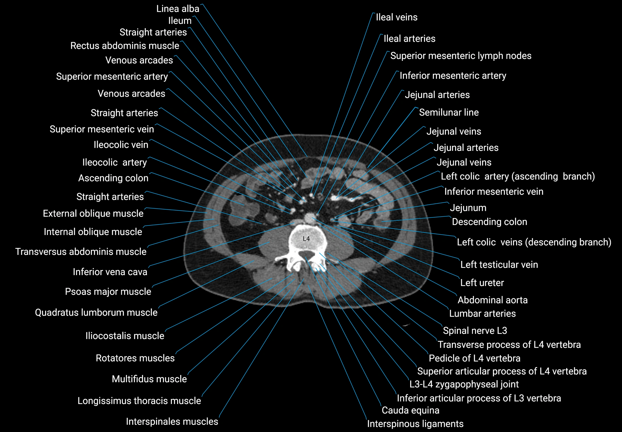 CT male pelvis axial cross sectional anatomy labelled radiology image -00104.webp